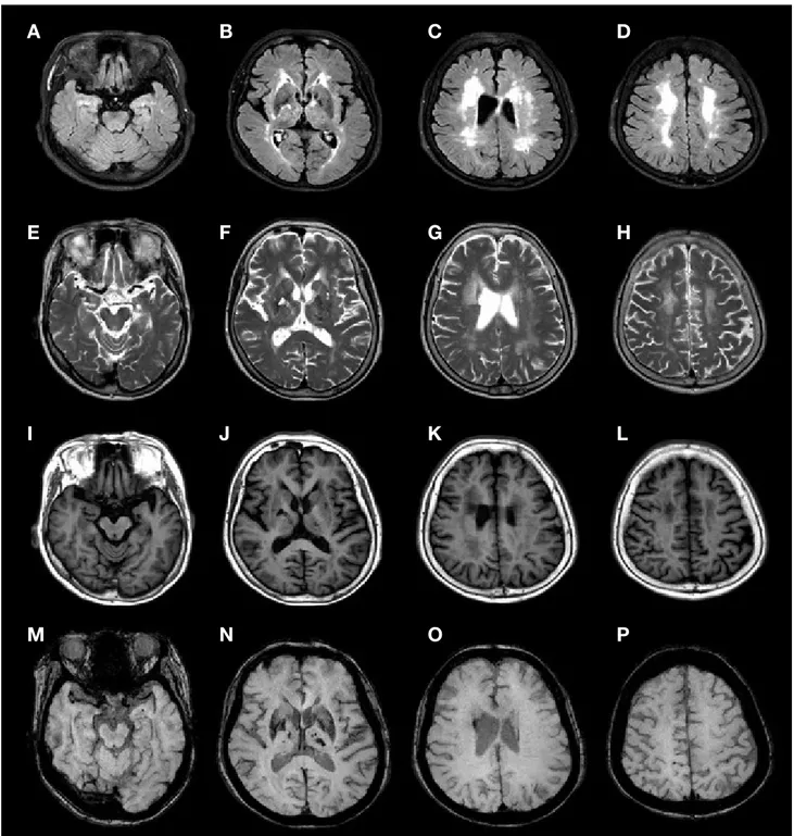 Figure 3.  Representative brain MRI findings in patients with CADASIL. Fluid-attenuated inversion recovery images (A~D) show periventricu-