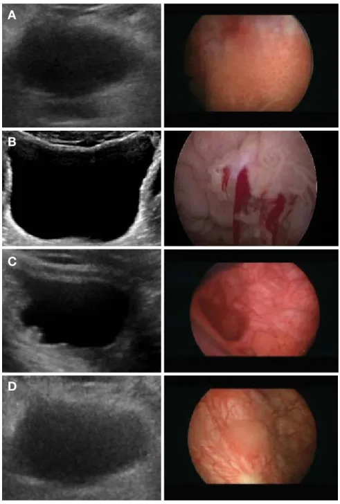 Fig. 1.  Bladder sonographic and cystoscopic findings. A: Sonographic findings: No bladder full filling, No lesion