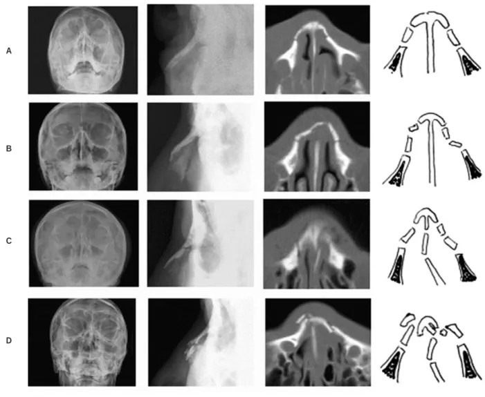 Fig. 1. Classification of nasal bone fractures. 