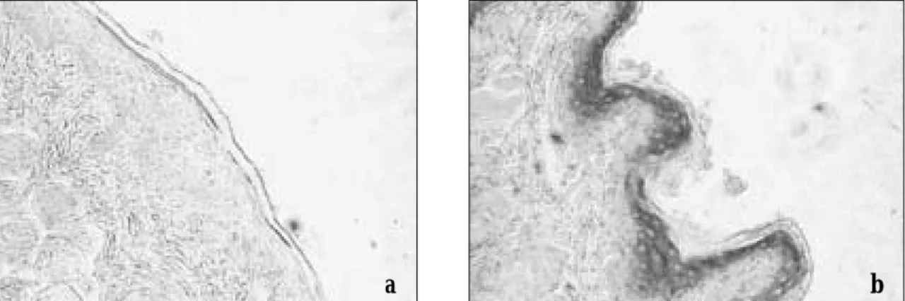 Fig. 3. Immunohistochemical expression of VEGF in hamster buccal pouch oral carcinogenesis model