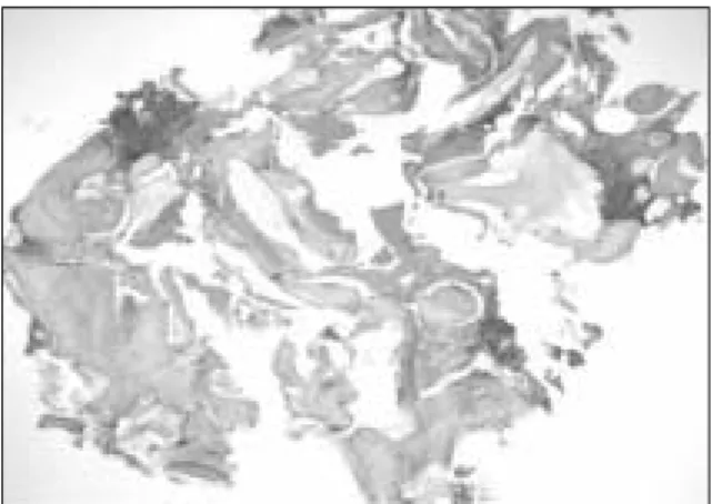 Fig. 7. Thick woven bone around a few implanted Bio- Bio-Oss chips (asterisks) is seen