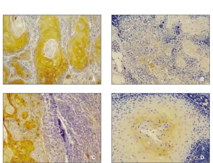 Table 3. The expression of TGF-β1 and MMP-2 in the metastatic lymph node