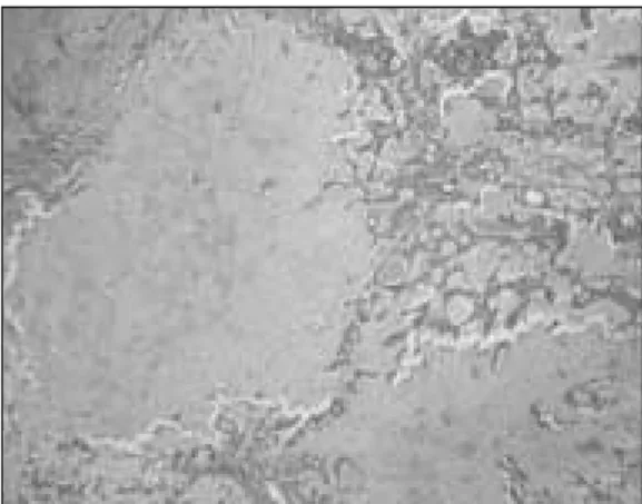 Fig. 2. Pleomorphic  adenoma  :  scattered  spindle cells forming networks in myxoid stroma.
