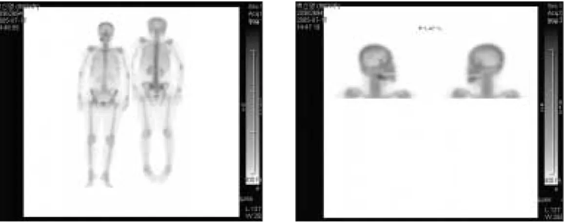 Fig. 4. Preoperative bone scanning showing a strong up take at the Rt. Mn. 
