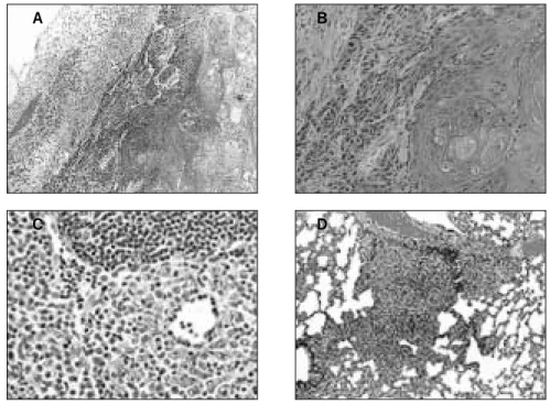 Fig. 9. Histologic features of subcutaneous SCC.