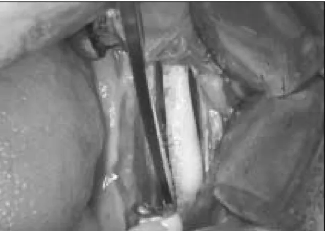Fig. 1. Initial panoramic and CT view show horizontal resorption of maxillary anterior alveolar ridge