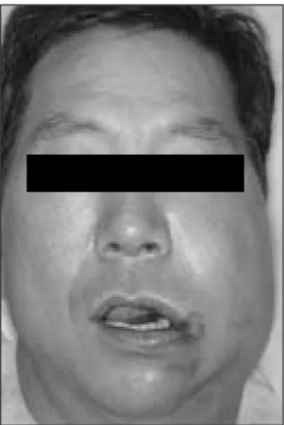Fig. 9. Initial  photograph  showing  swelling  on  left cheek.