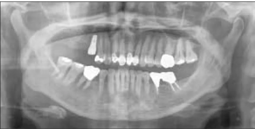 Fig. 16. After bone grafting was performed, the grafted bone was covered with resorbable collagen membrane