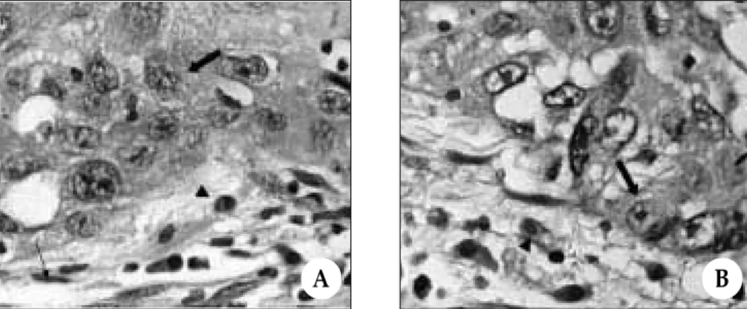 Fig. 4. Representative photomicrographs of staining for vascular endothelial growth factor receptor-3 (VEGFR-3) in biopsy (A) and radical excision specimen (B)