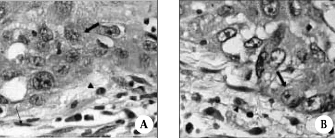 Fig. 4. Representative photomicrographs of staining for vascular endothelial growth factor receptor-3 (VEGFR-3) in biopsy (A) and radical excision specimen (B)