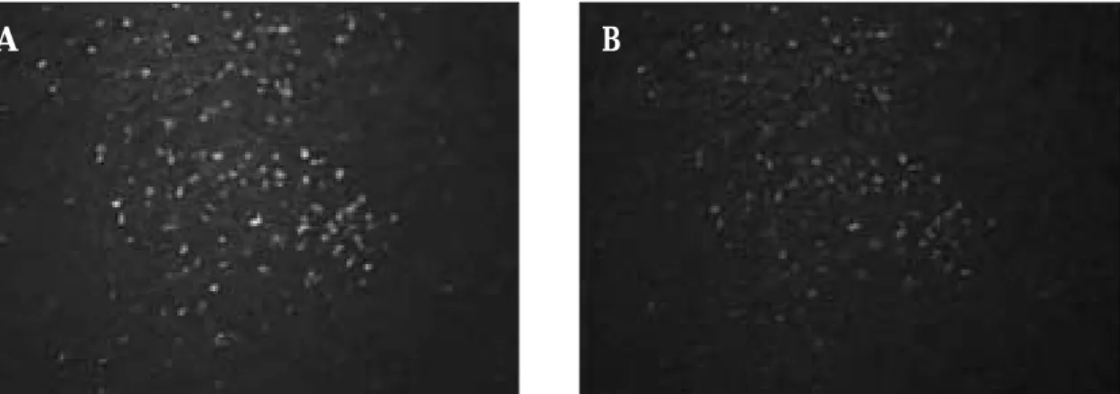 Fig. 6. Double immunofluorescence staining for vascular endothelial growth factor receptor-3 (VEGFR-3, green) and CD68 (red) in the tumor-associated macrophages
