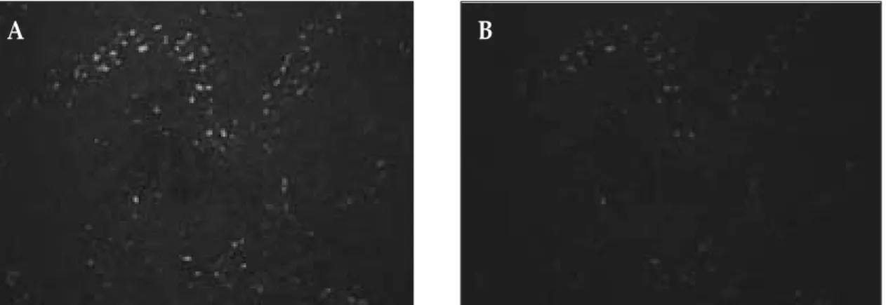 Fig. 8. Double immunofluorescence staining for vascular endothelial growth factor receptor-3 (VEGFR-3, green) and 5B5 (red) in the stromal fibroblasts