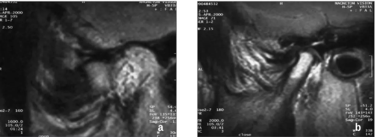 Fig. 1. MRI in anterior disc displacement.