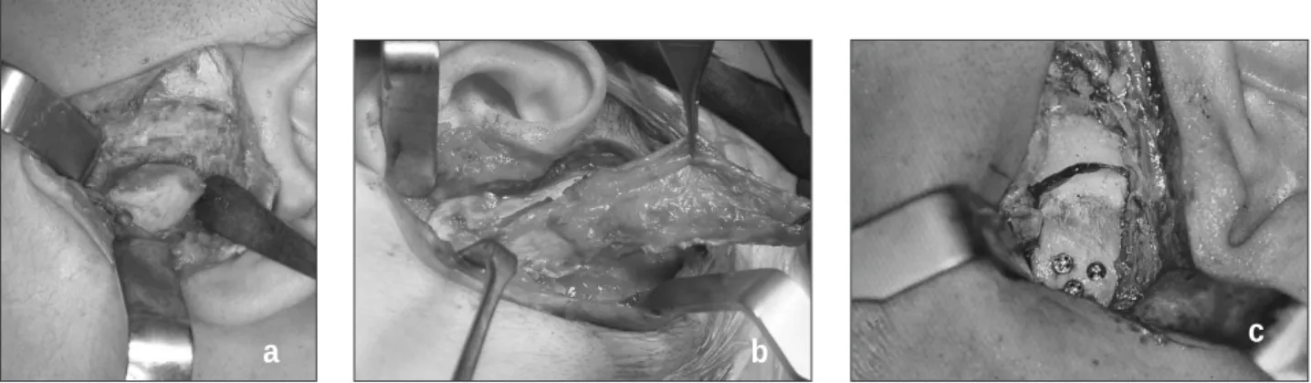 Table 7. Clinical features of the TMJ benign tumors patients.