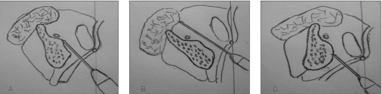Fig. 1. Schematic  drawing  of  the  mandibular  ramal  angle  and  insertion  of  a  needle