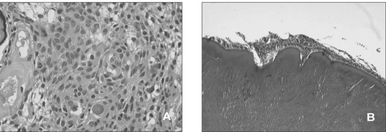 Fig. 3. A and B, Mass is consisted of loose fibrous connective tissue and dentigerous hard tissue.
