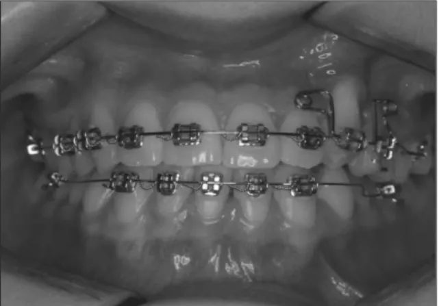 Fig. 6. Root  coverage  of  the  left  maxillary  canine using free gingival graft. (postoperative 30months)