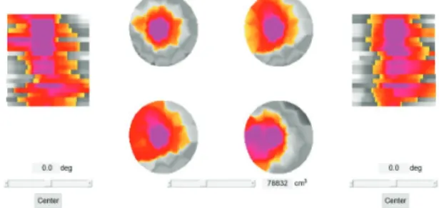 Fig.  8은  단풍  수목의  단층  영상을  이용하여  3D  영상을  구현하여  건강한  부분을  회색으로  나타내 며 실제 부후가 진행된 부분을 선택하게 하여 선택  부분의  부피를  측정한  결과  78,832  cm 3   면적이  부 후  면적으로  측정되었다