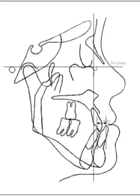 Fig. 2. Reference  landmarks  and  planes  on  poste- poste-roanterio cephalogram are illustrated
