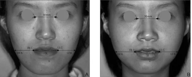 Fig. 3. Reference  landmarks  and  planes  on  clinical  photograph  are  illustrated