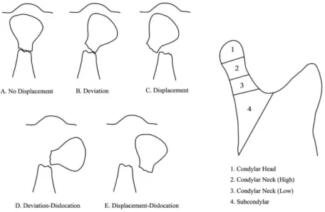 Fig. 1. Classification of mandibular condylar fracture (modified from 久 and Lindahl 4,5 ).
