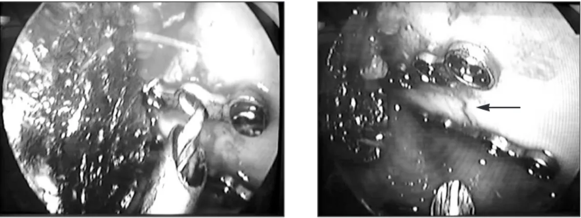 Fig. 6. Fixation  as  visualized  through  the  endoscope.  Black  arrow  points  to  the  fracture  line.