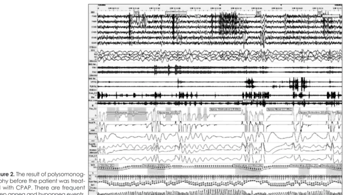Figure 2. The result of polysomonog-
