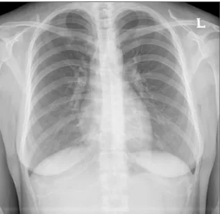 Fig. 2. Chest  P-A  shows  hazziness  of  both    lung, especially  left  lower  lung  field  air  bronchogram (typical  finding  of  pulmonary  edema)  at  immediate postoperatively.