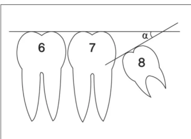 Fig. 1. Determining  the  angulation  of  a  mandibular third molar.