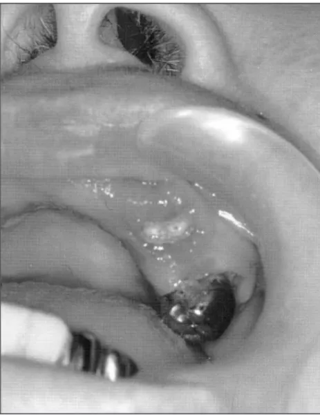 Fig. 5. (#  24)  crown  removal  &amp;  primary  endodontic drainage view.