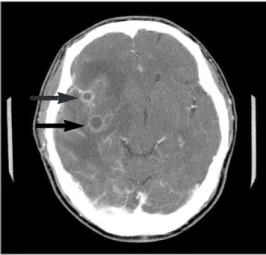 Fig. 6. T 2 weighted  MRI  shows  encephalomalacia  in right  temporal  lobe(large  arrow)  and  insular cortex(small arrow), due to post-op change.