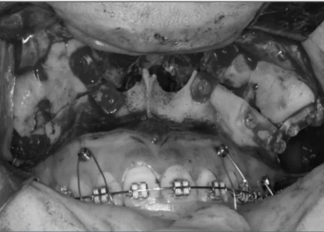 Table 2. Clinical data of application of bioabsorbable plates in orthognathic surgery