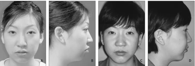 Fig. 1. This  patient  underwent  orthognathic  surgery  accompanied  maxillary  impaction,  mandibular  setback  with  bilateral vertical ramus osteotomy, and vertical height augmentation genioplasty with horizontal advancement