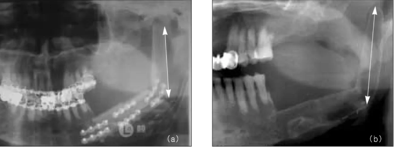 Fig. 2. Change of condylar shape after fibular reconstruction. Dome shaped condyle remodeling was observed