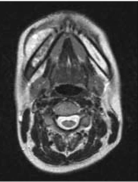 Fig. 10. Bone  scan  image  of  initial  state.  Hot uptake was observed in right mandible