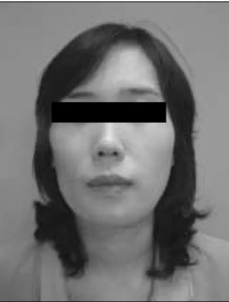 Fig. 13. Frontal  photograph  taken  after  Gore-tex � augmentation  in  right  buccal  cheek  (2  years primary operation)
