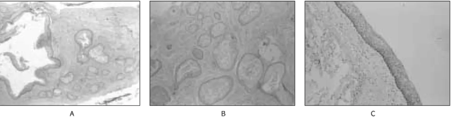 Fig. 2. (a)  Simultaneous  occurrence  of  an  odontogenic  keratocyst  (*)  and  squamous  odontogenic  tumor  (arrow)  were observed