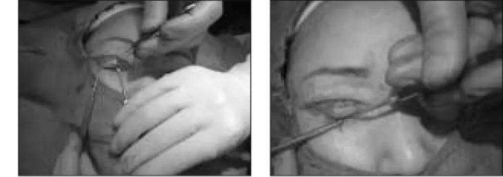 Fig. 1. Incision method