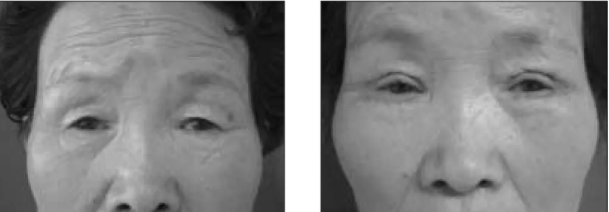Fig. 6. Visual disturbance due to dermatochalase. preoperative(left) and postoperative(right) state
