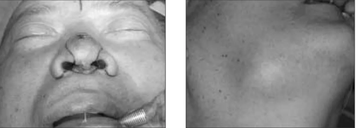 Fig. 1. Preoperative  views.  Note  the  cancer  lesions  on  external  nose  (Lt.)  and  large  mass  on  Rt