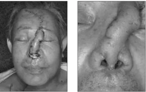Fig. 4. Immediately  after  (Lt.)  and  3  weeks  later  (Rt.)  of  the  forehead  flap  on the nasal defects.