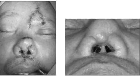 Fig. 6. Immediately after the forehead flap division and the nasal tip augmentation (Lt)
