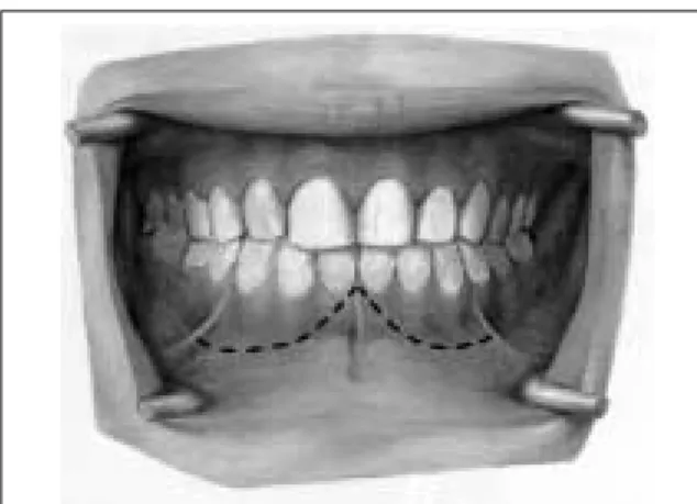 Fig. 1. Schematic drawing of ‘gull-wing’type incision Fig. 3. Postoperative wound healing
