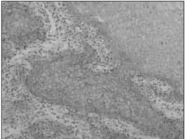 Fig. 1. E-cadherin  immunostaining  patterns  in  oral squamous  cell  carcinoma(×100)