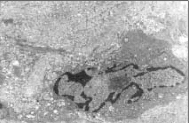 Fig. 7. TEM view of Tumor Mass Tissue  Fig. 8. TEM view of Experimental Group (at Week 2) 