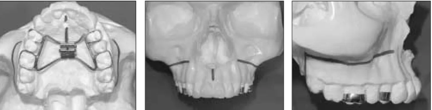 Fig. 1. Surgically assisted rapid maxillary expansion(Device and osteotomy line)