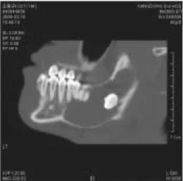 Fig. 5. Preoperative CT view Fig. 6. Cortical plate is expanded