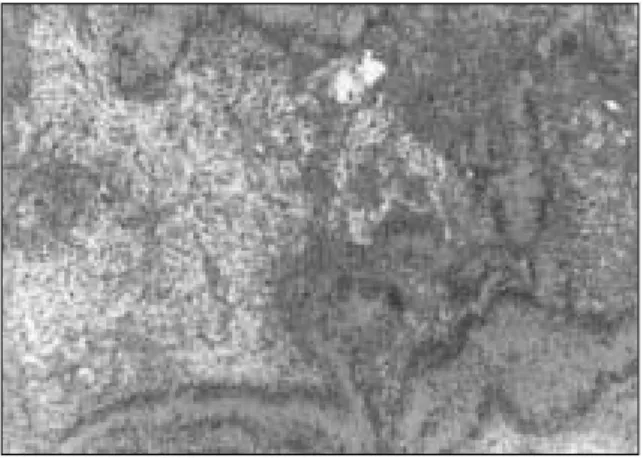 Fig. 12. Histopathologic  findings  (H-E  stain  × 400) Spindle-shaped  cells  of  the  Antoni  type  A  tissue  and Antoni type B tissue shows Schwann cells dispersed in a  loose  and  random  fashion  with  a  meshwork  of delicate  reticulin  fibers  an