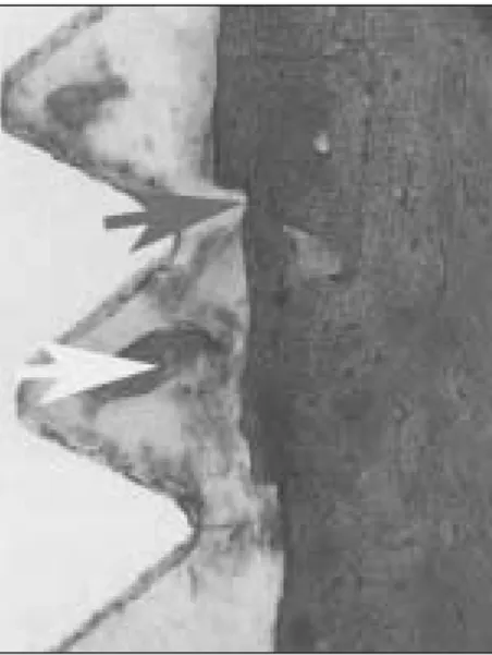 Fig. 2. 2nd  week  HA  implant  group  with  saline irrigation(×100).  Some  woven  bone  and  amorphous layer(white  arrow)  was  observed