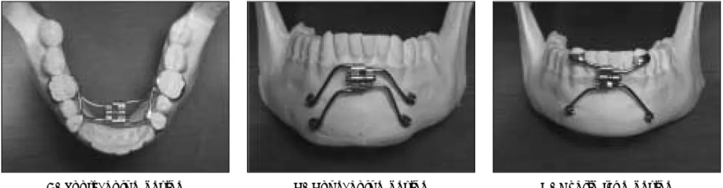 Fig. 1. Distraction applience of Wonkwang protocol